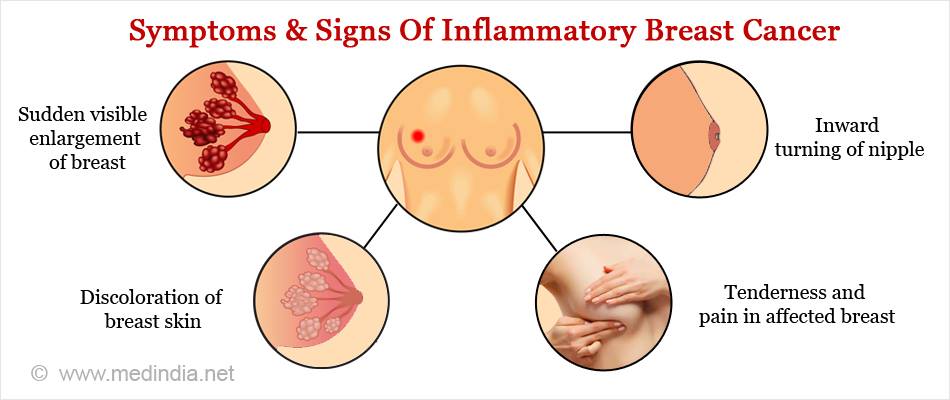 10 symptoms of breast cancer