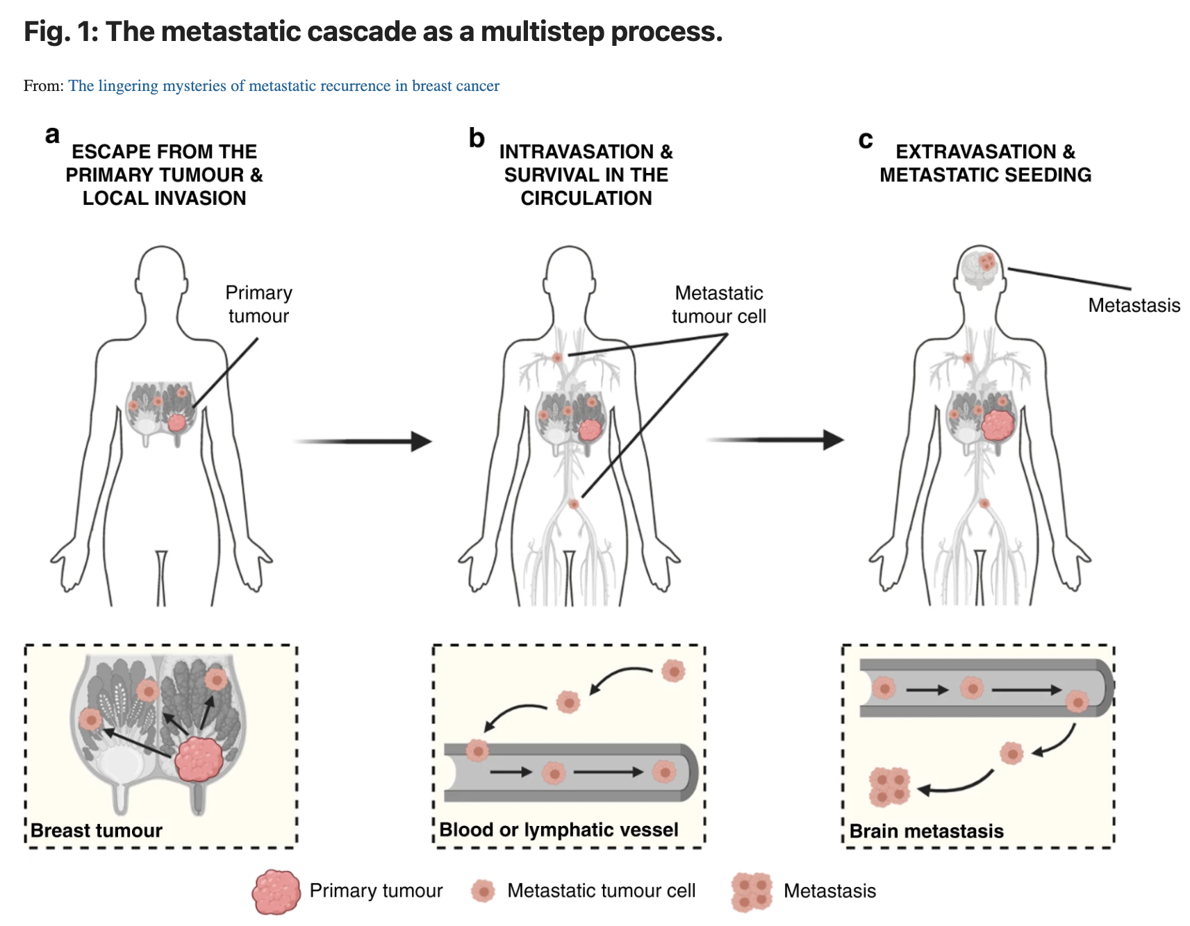 ‘the Lingering Mysteries Of Metastatic Recurrence In Breast Cancer In